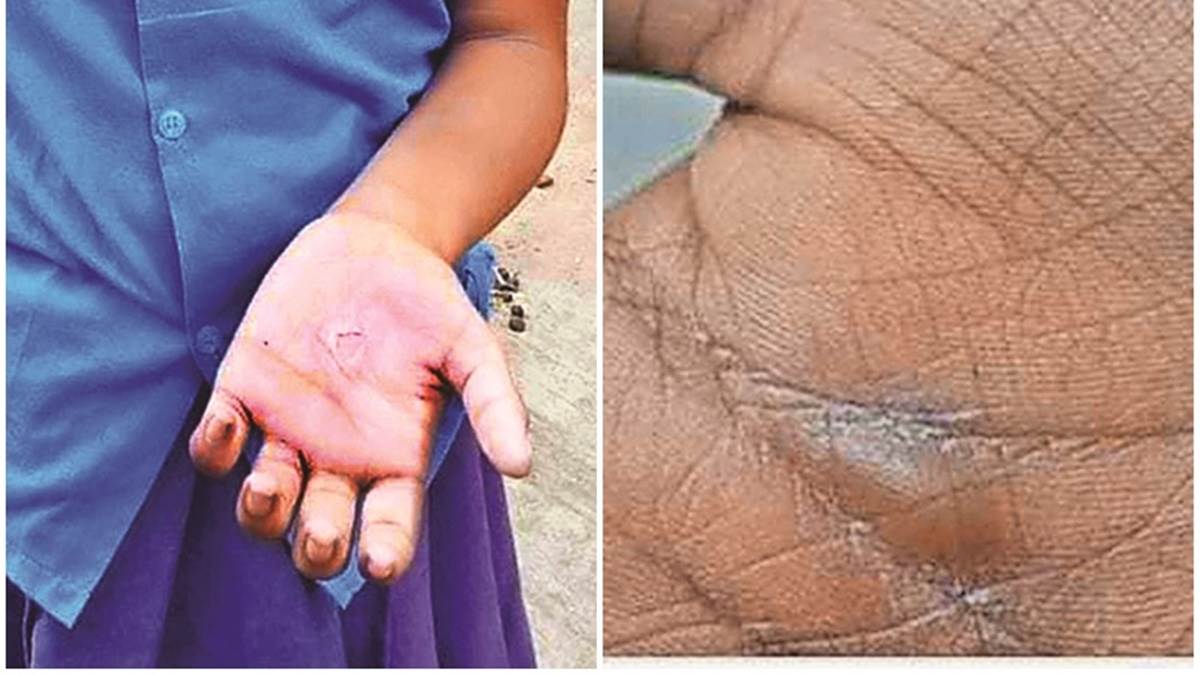 09 12 2023 boiling oil on hands in kondagaon