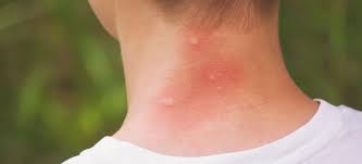 If you also want to get relief from insect bites then these tips will help
