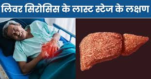 Liver Cirrhosis ke Lakshan Kya Hote Hain