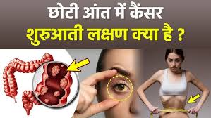 Small Intestine Cancer Symptoms