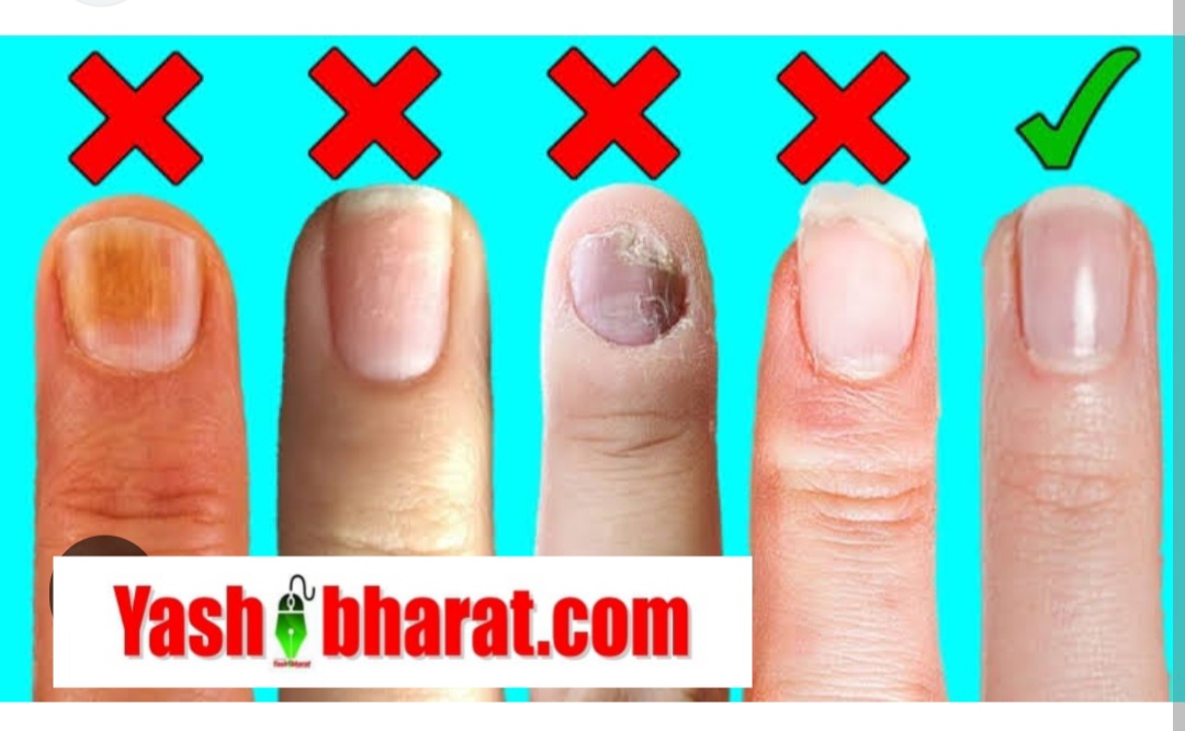 नाखूनों से जानें हार्ट, लिवर, ब्लड या पोषण की समस्या- ये हैं अहम संकेत
