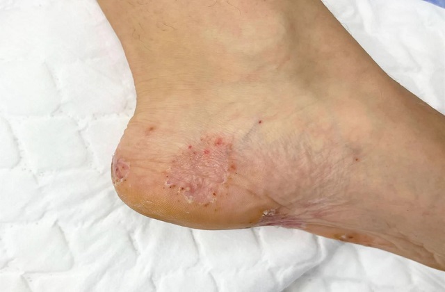 गर्मी में फुटवियर की ये 5 गलतियां पड़ सकती हैं भारी, बढ़ सकता है Fungal Infection का खतरा