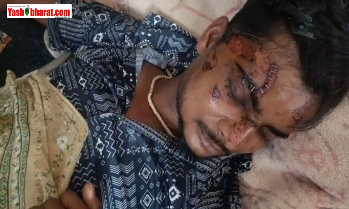 अलीगढ़: जेब में रखा Motorola का फोन अचानक ब्लास्ट, डिलीवरी बॉय झुलसा; इलाज के दौरान चेहरे पर लगाए गए स्टेपलर